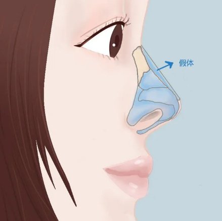 莫娜麗莎的玻尿酸多少錢一支？