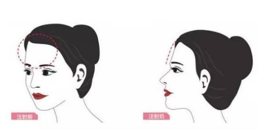 臉部填充脂肪能維持多久要多少錢？