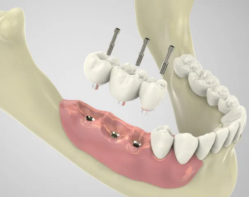 登騰種植牙和奧齒泰種植牙哪個好？