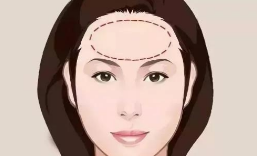 喬雅登雅致適合做哪些部位？皺紋拜拜|玻尿酸去抬頭紋案例附上