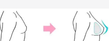 隆胸1.png 隆胸1.png