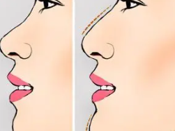 隆鼻4.png 隆鼻4.png