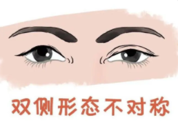 雙眼皮14.png 雙眼皮14.png