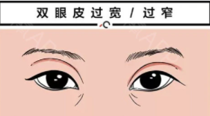 雙眼皮17 (2).png 雙眼皮17 (2).png