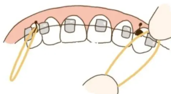 牙齒矯正11.png 牙齒矯正11.png