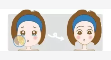 面部溶脂15 (2).png 面部溶脂15 (2).png