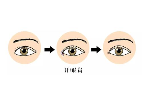 開(kāi)眼角2.jpg